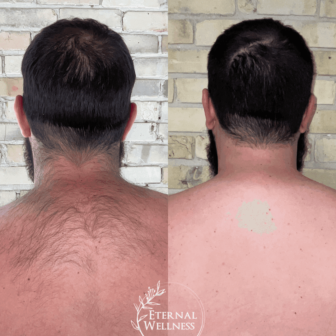 DiolazeXL Laser Hair Removal before and after
