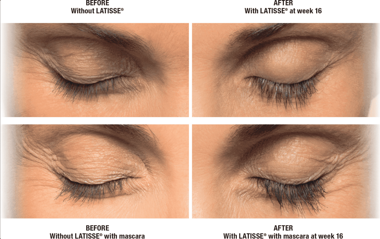 Latisse before and after