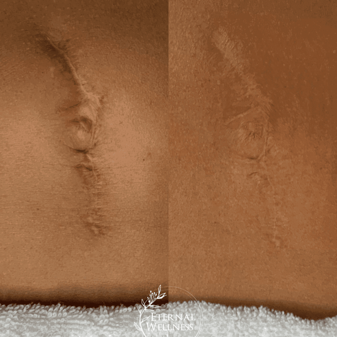 Morpheus8 Body before and after