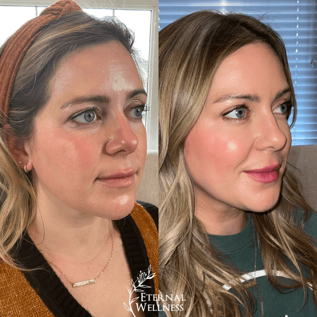 Dysport before and after