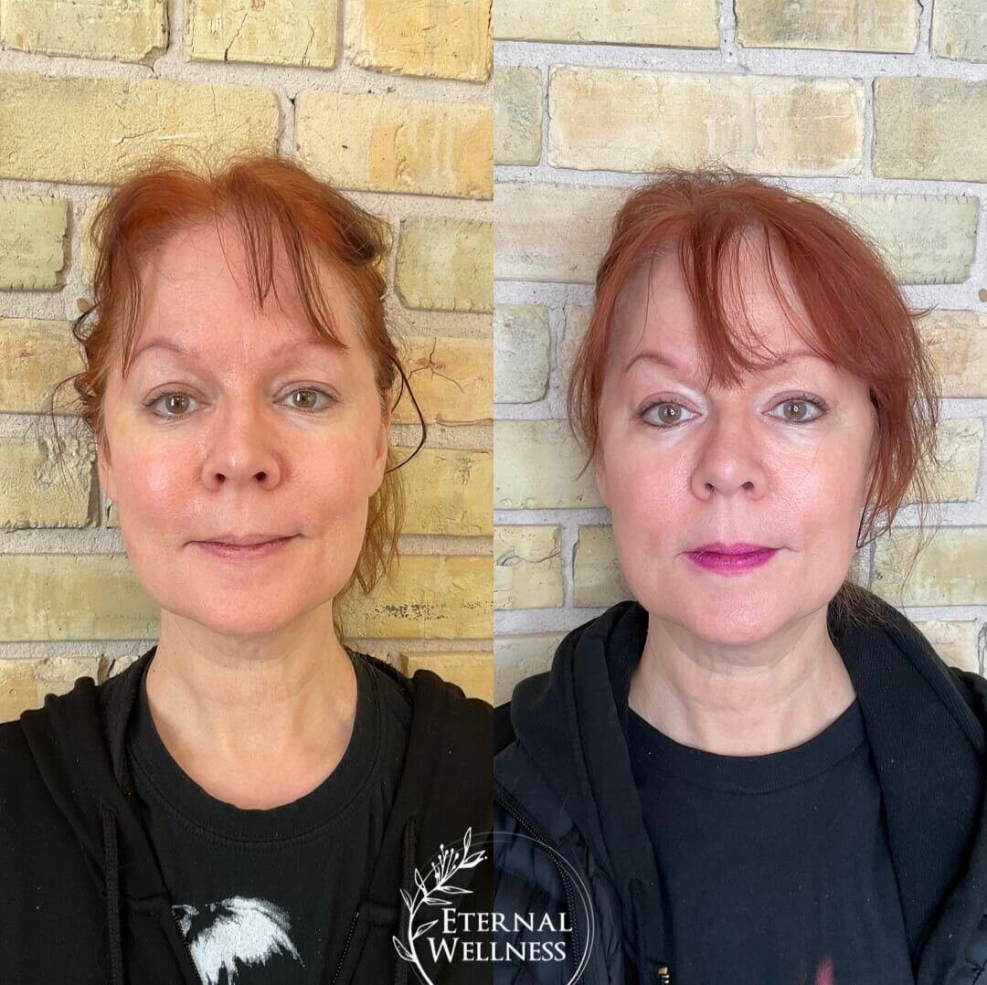 Morpheus8 Face before and after