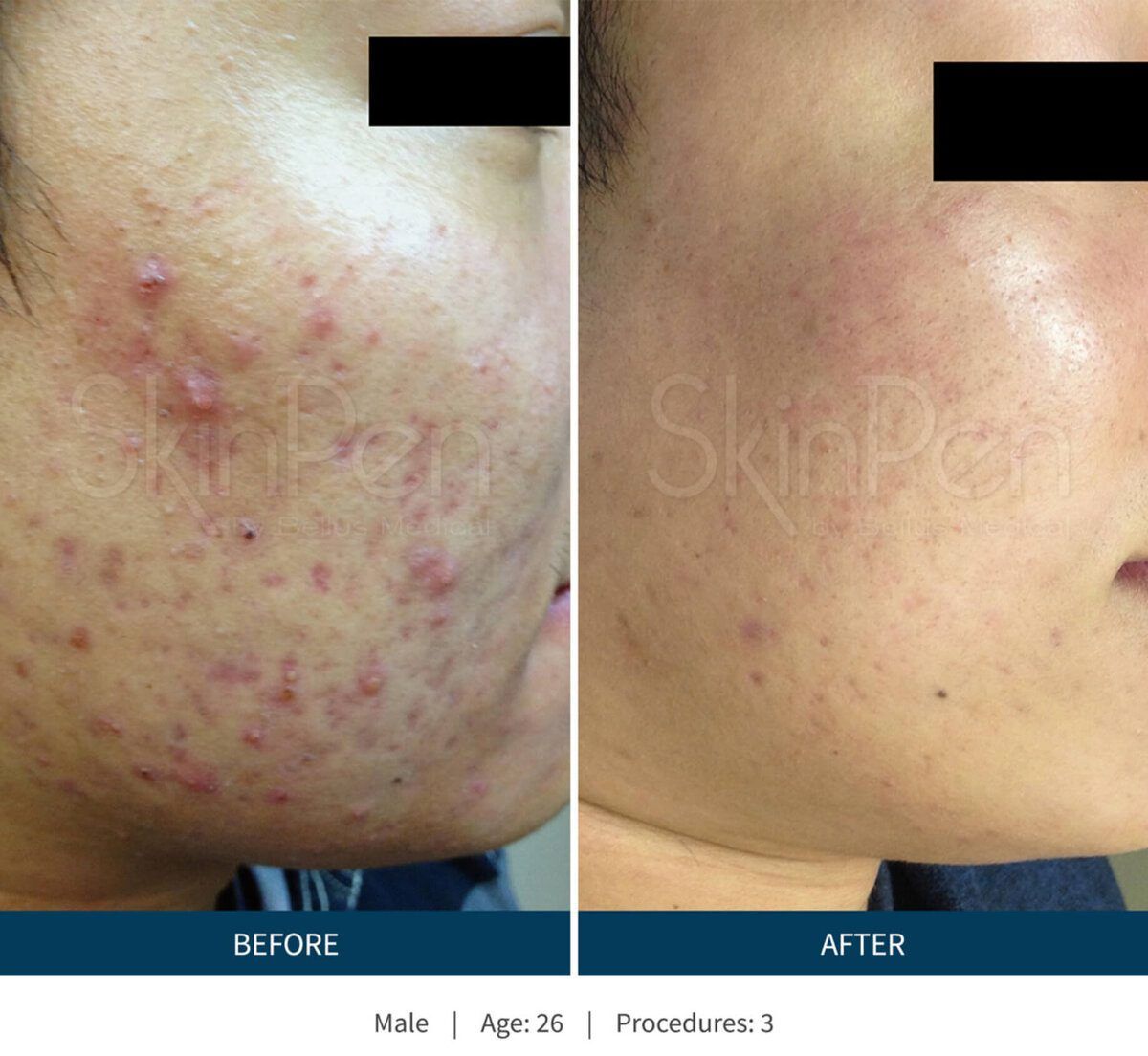 SkinPen before and after