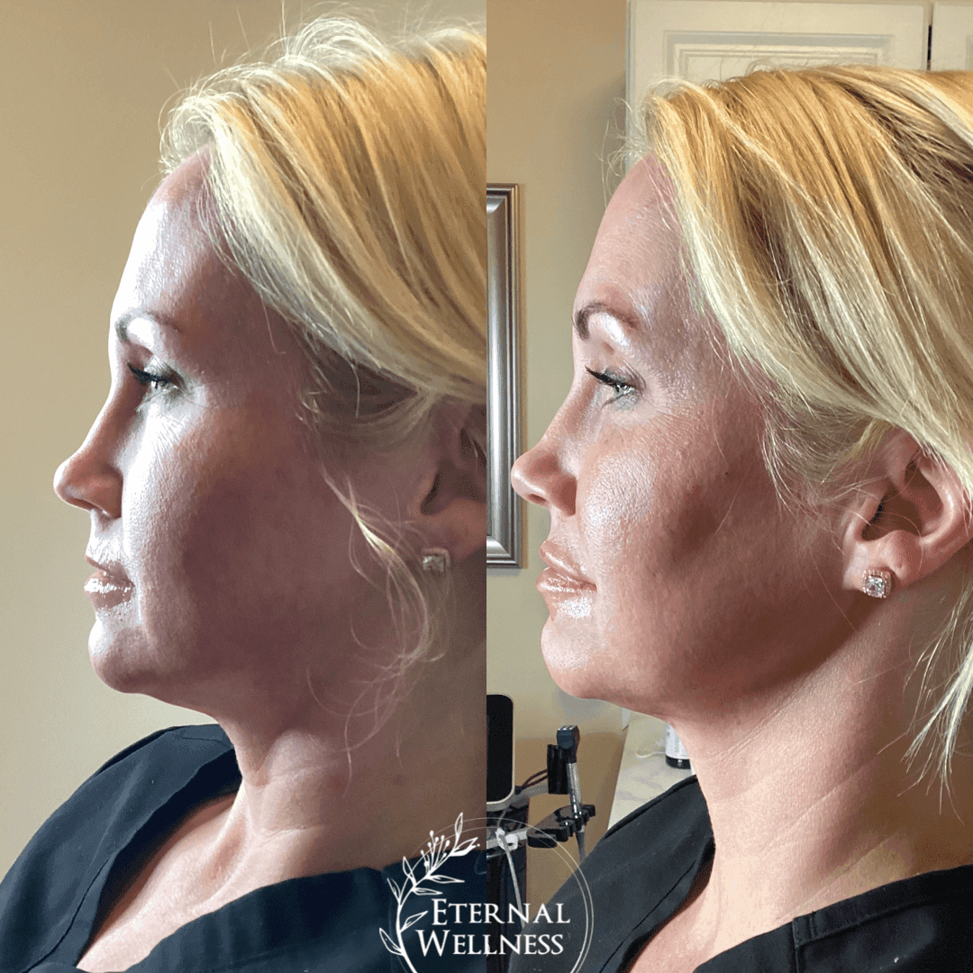Dermal Fillers before and after