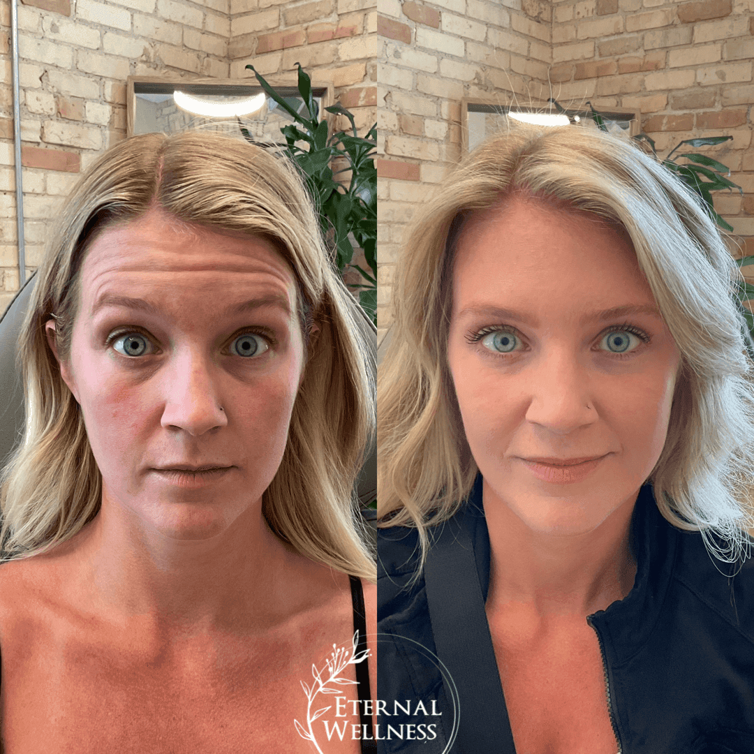 Dysport before and after