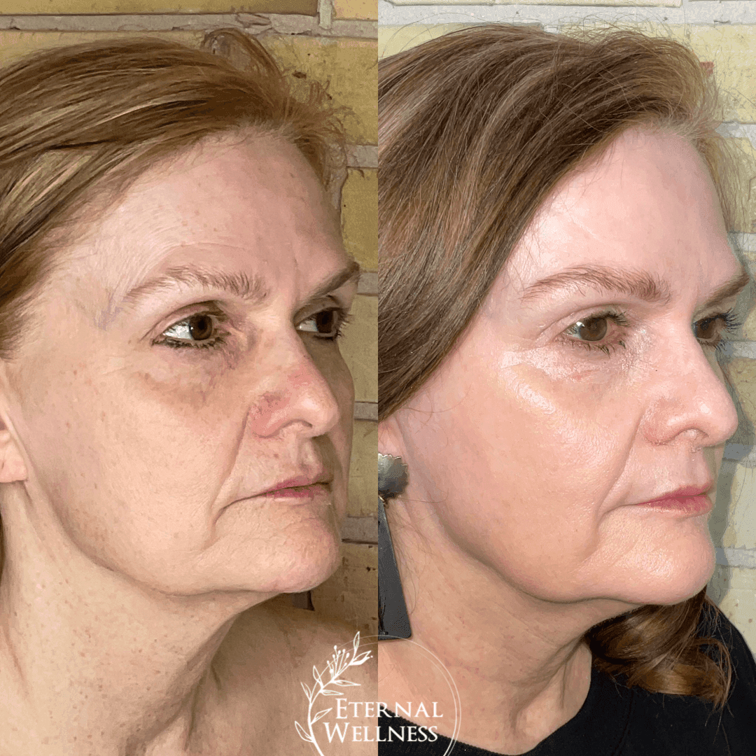 Morpheus8 Face before and after