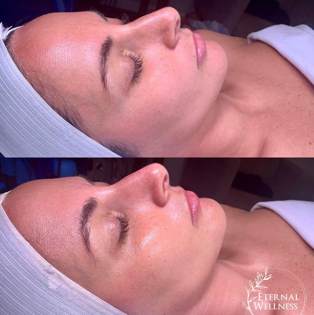 Hydrafacial before and after