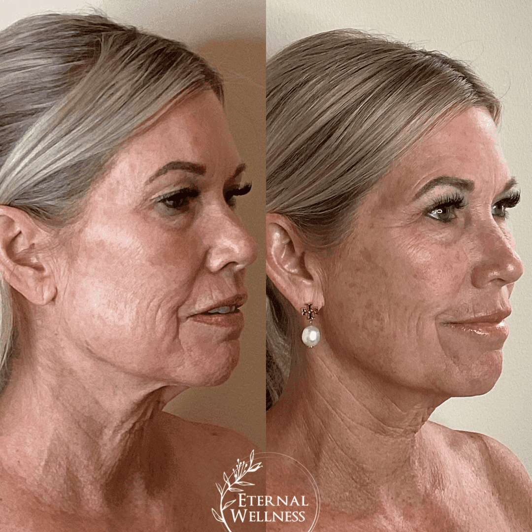 Forma RF before and after