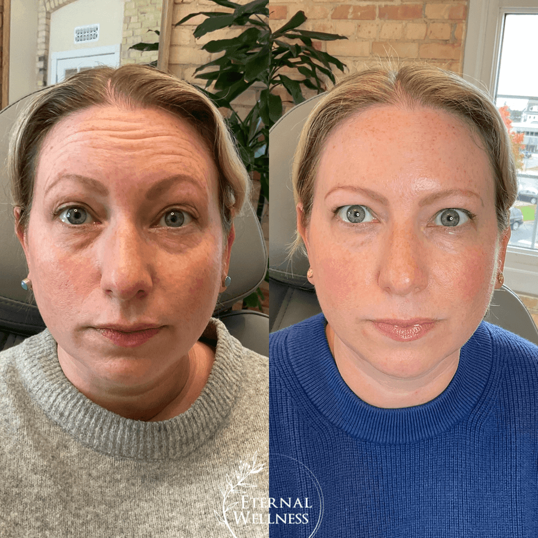 Botox before and after