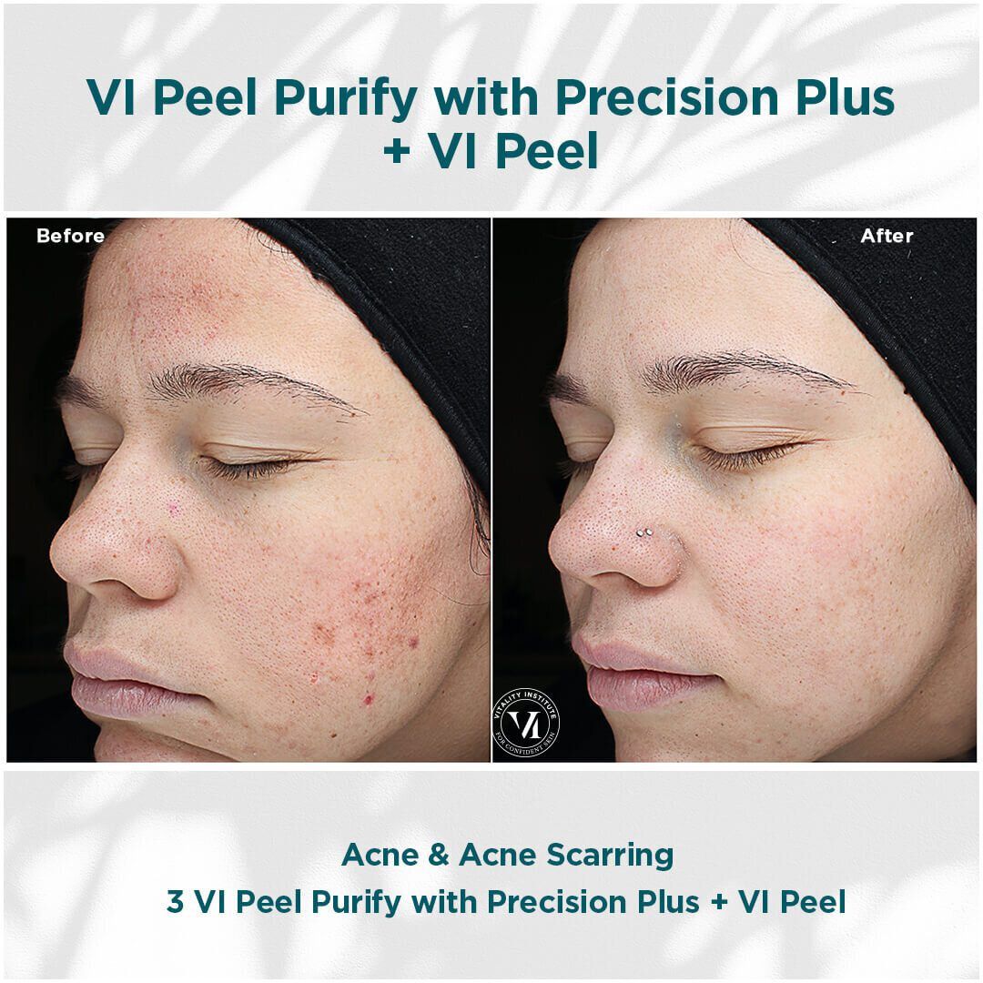 VI Chemical Peel before and after