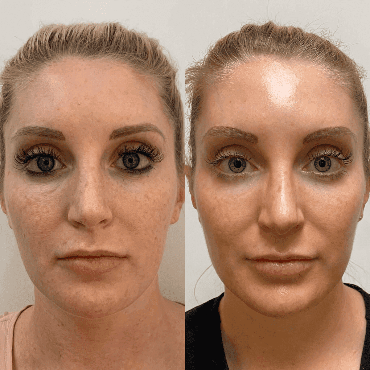 PRP & PRF before and after