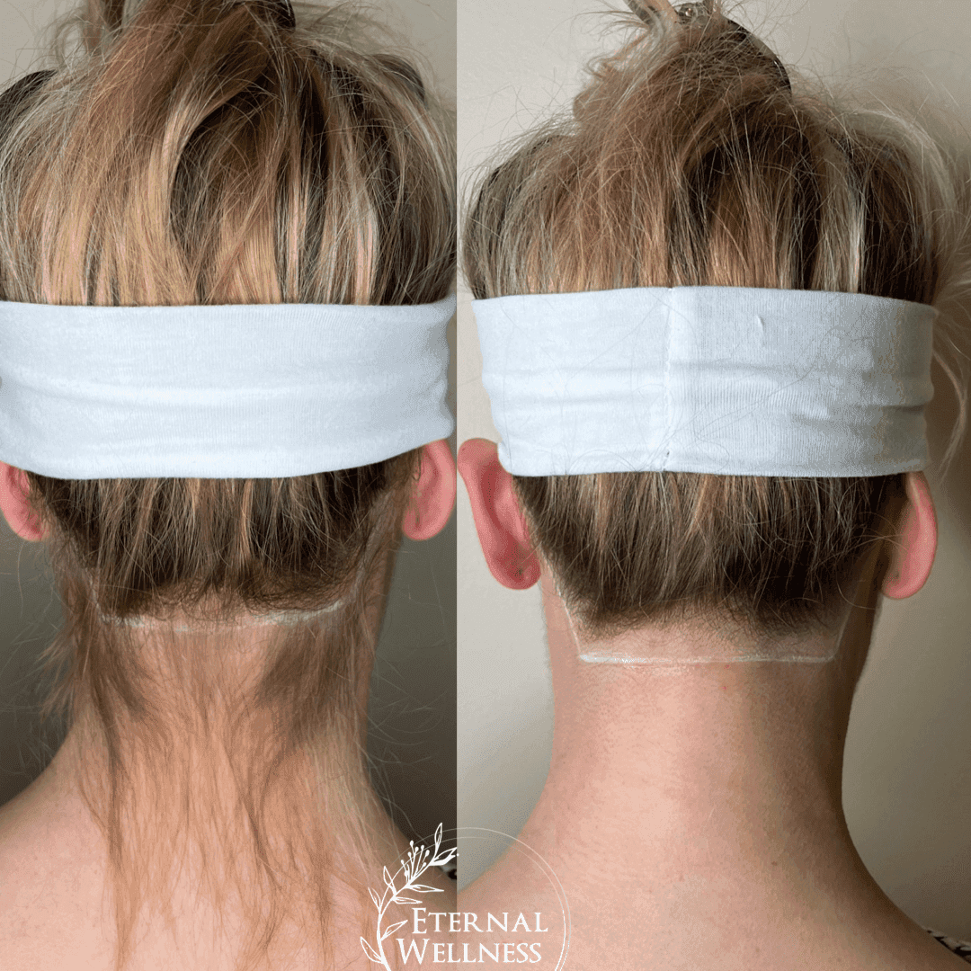 DiolazeXL Laser Hair Removal before and after