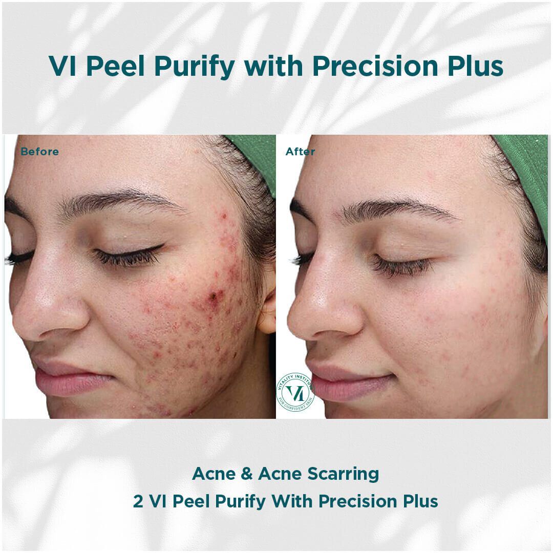 VI Chemical Peel before and after
