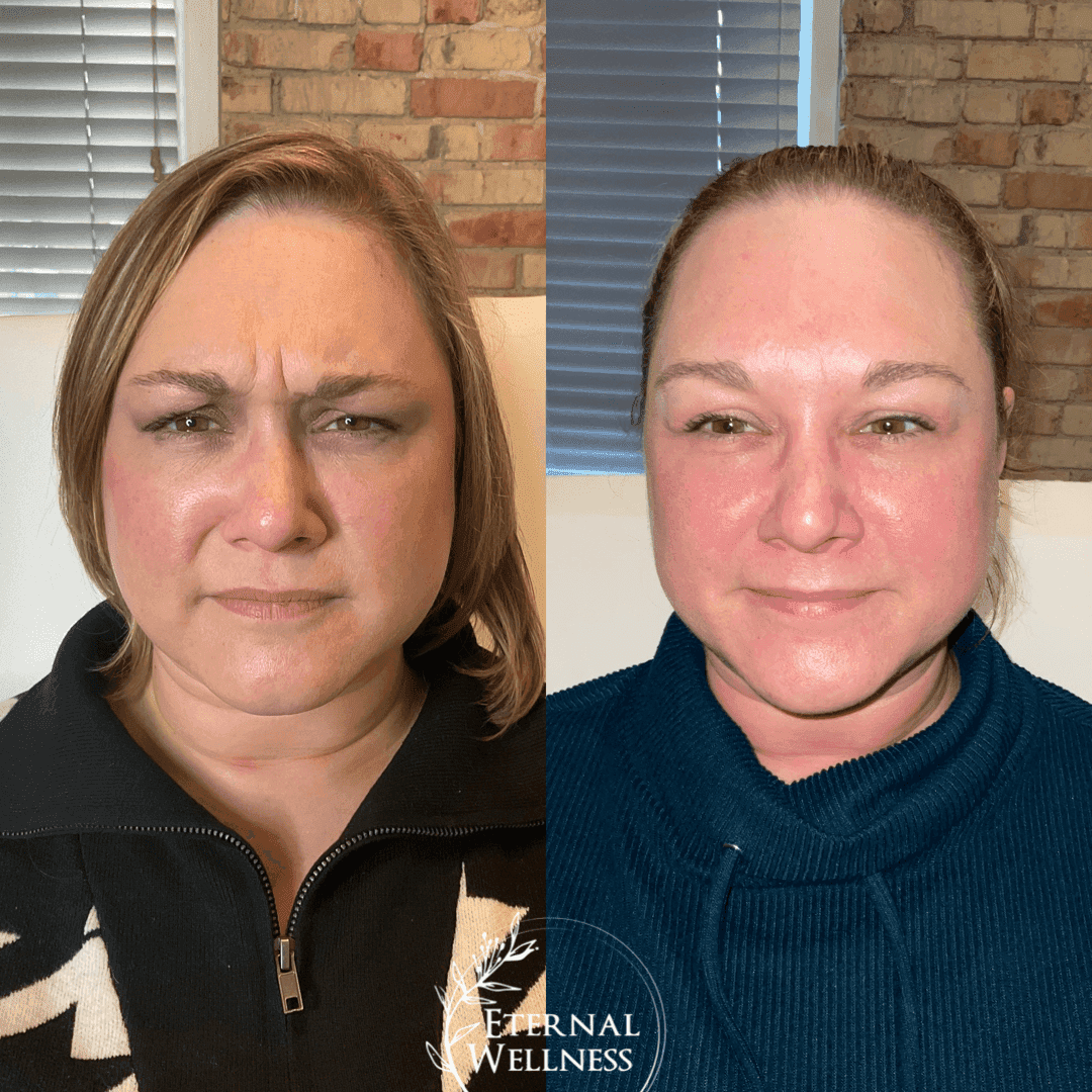 Dysport before and after