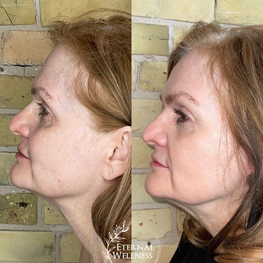 Morpheus8 Face before and after