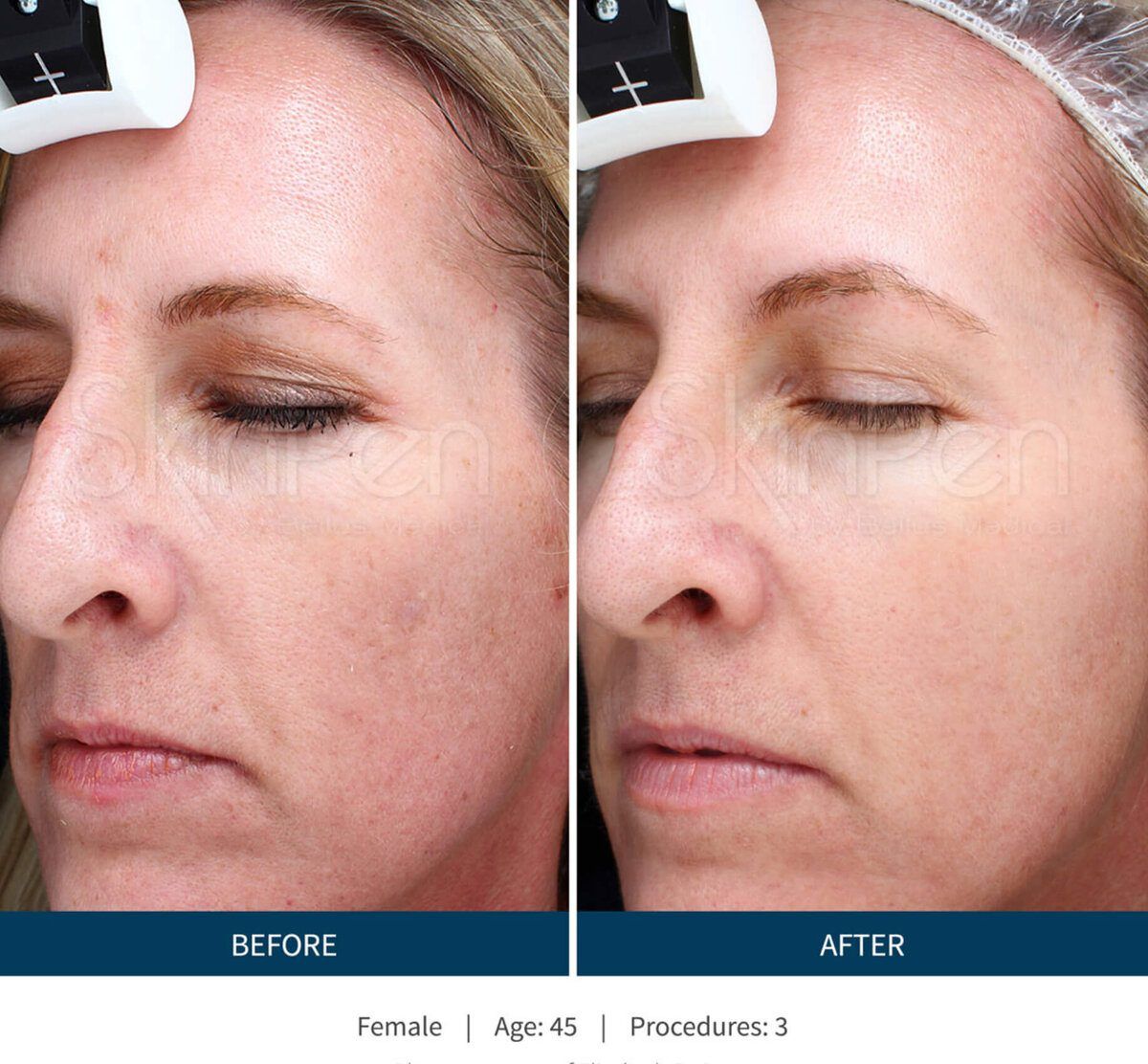 SkinPen before and after