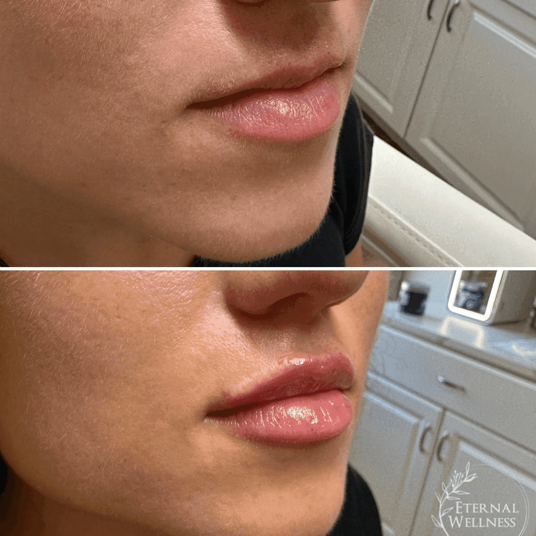 Lip Injections before and after