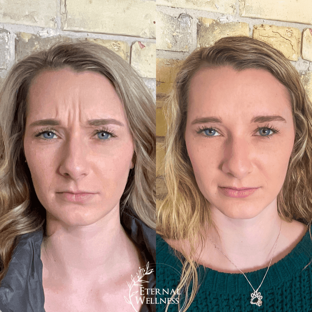 Botox before and after