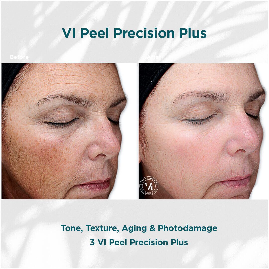 VI Chemical Peel before and after