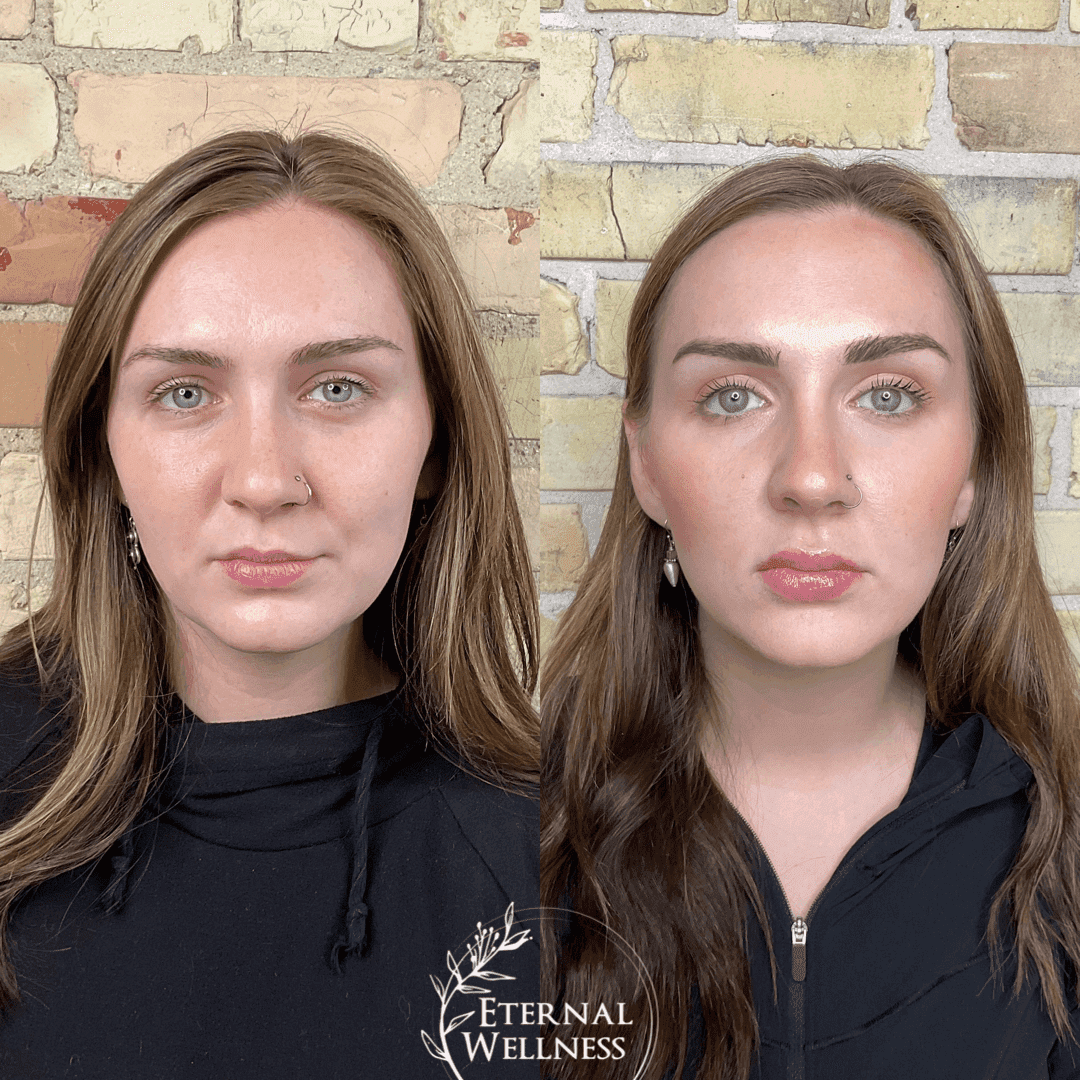 Dermal Fillers before and after