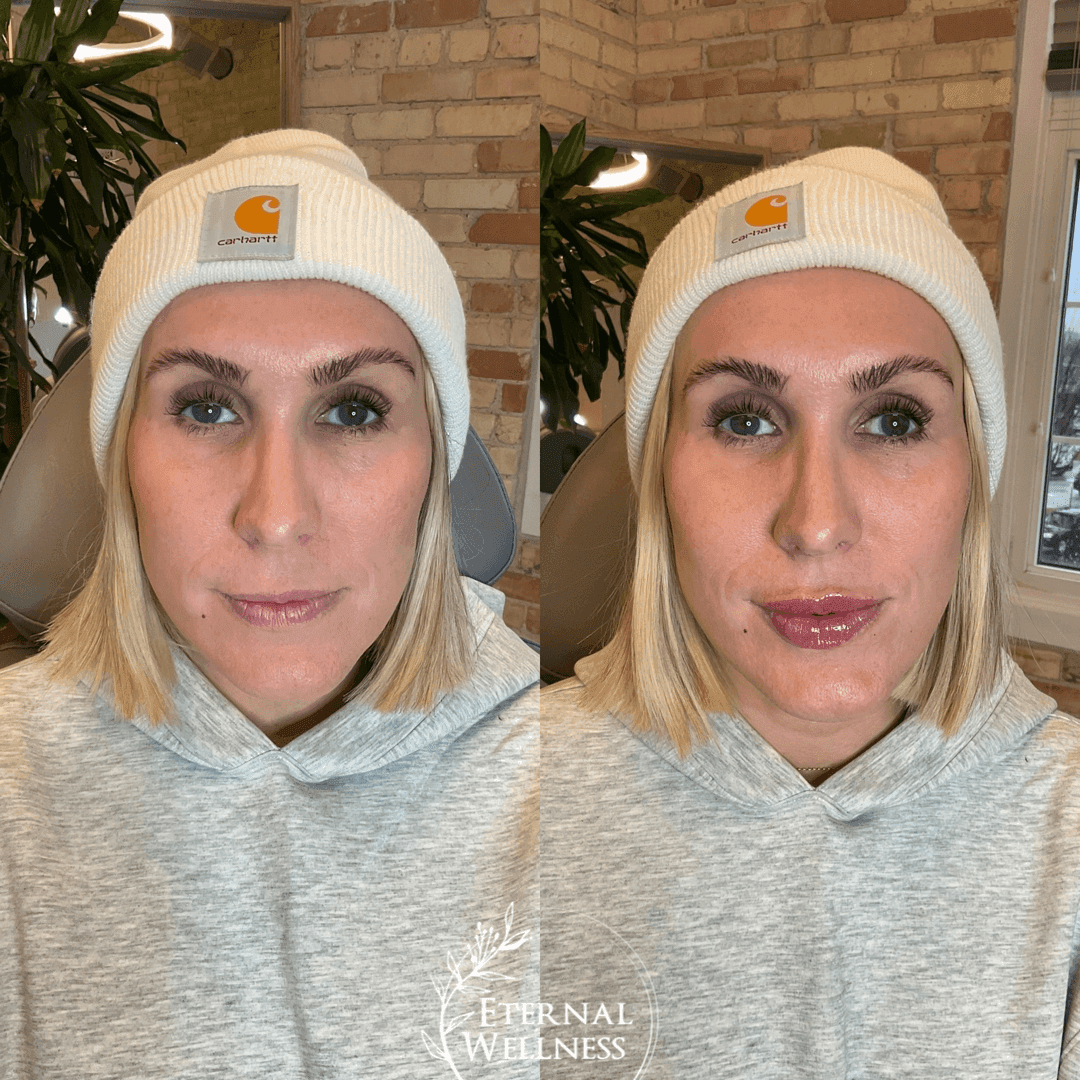 Restylane before and after