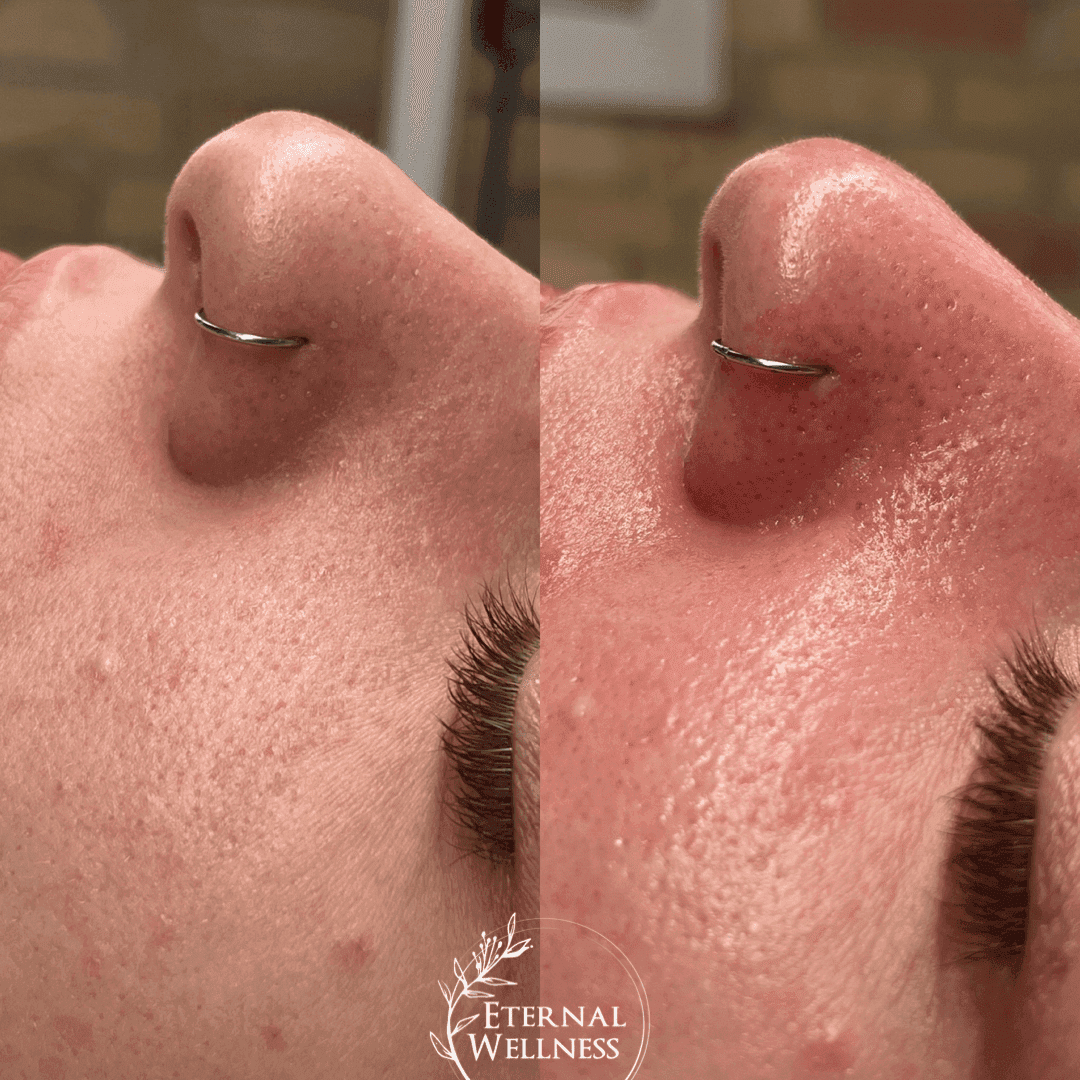 Hydrafacial before and after
