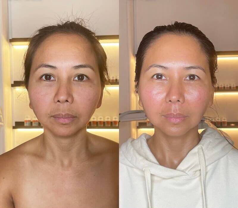 Lymphatic Drainage before and after