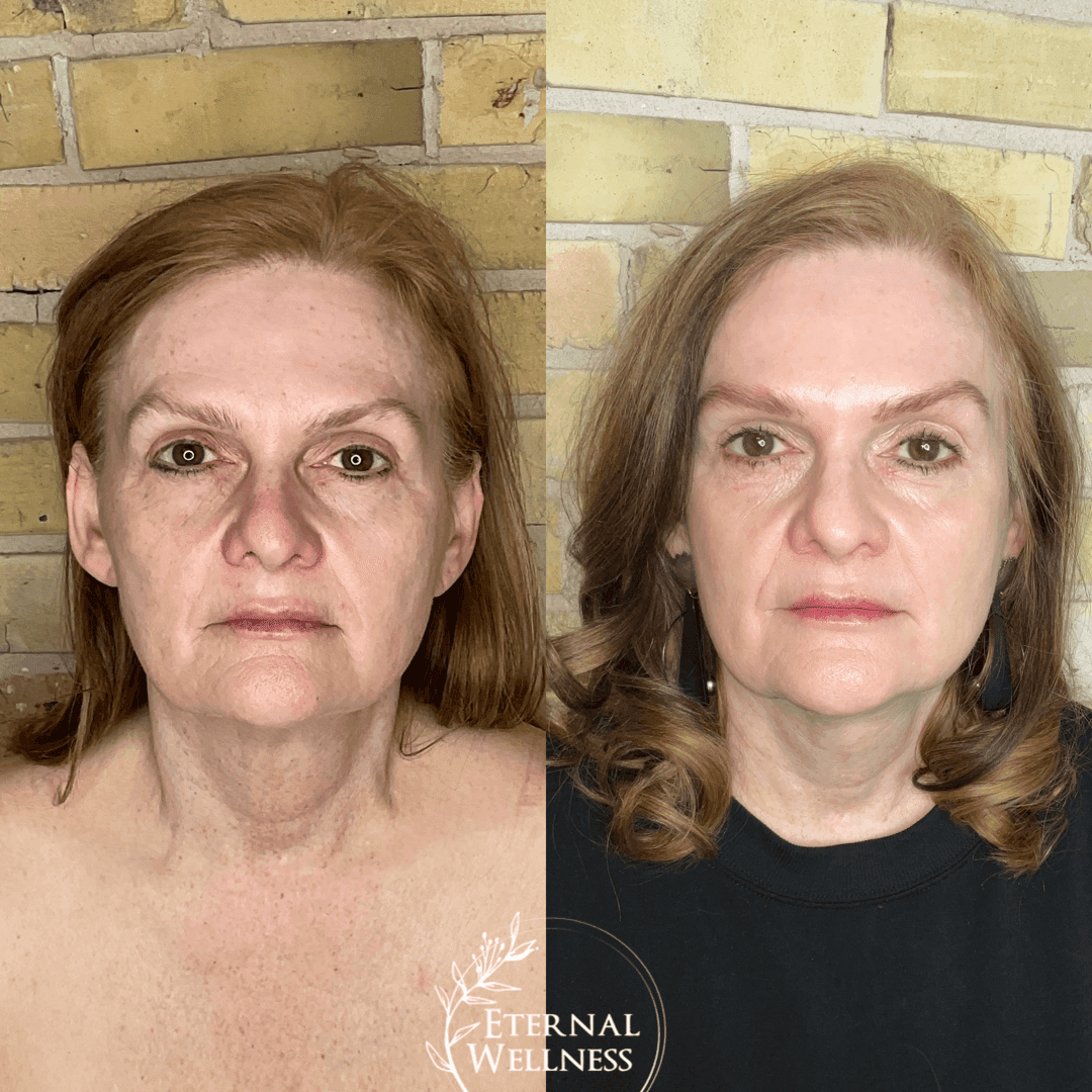 Morpheus8 RF Microneedling before and after