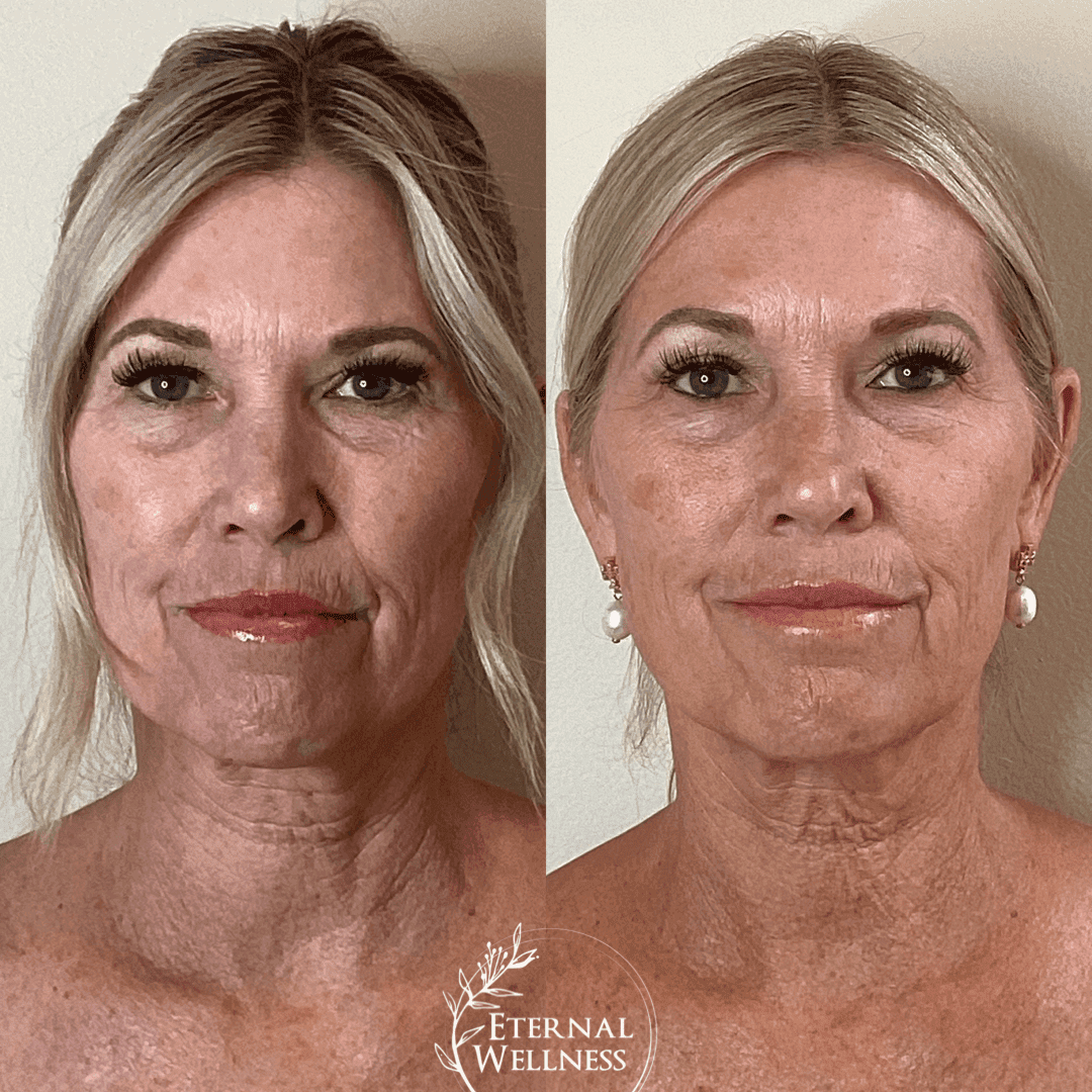 Forma RF before and after