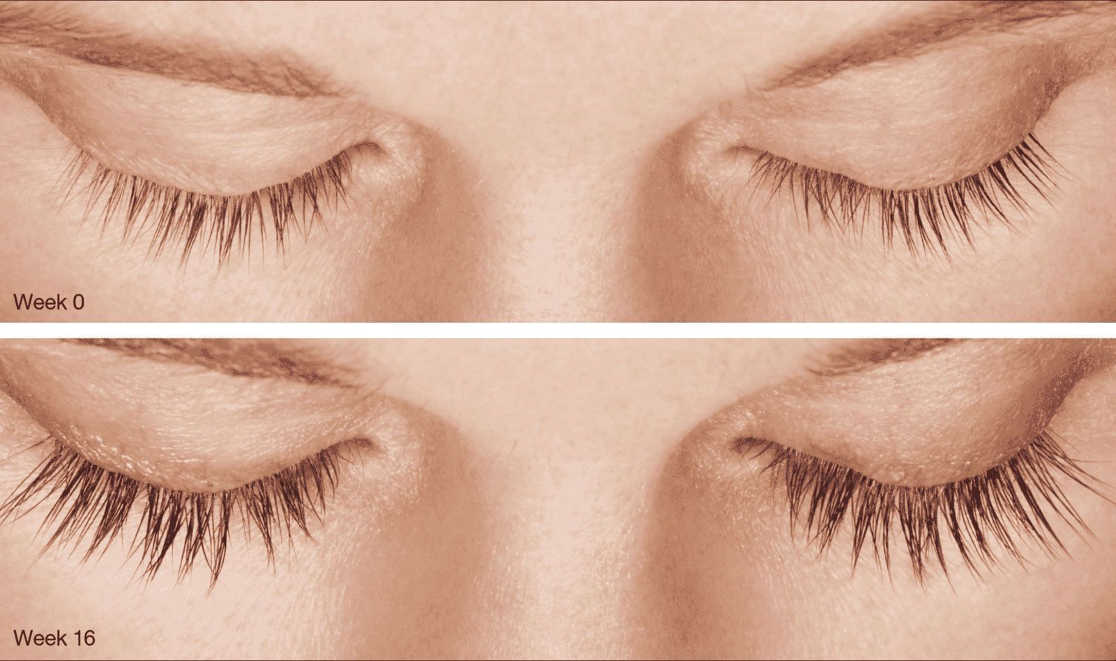 Latisse before and after