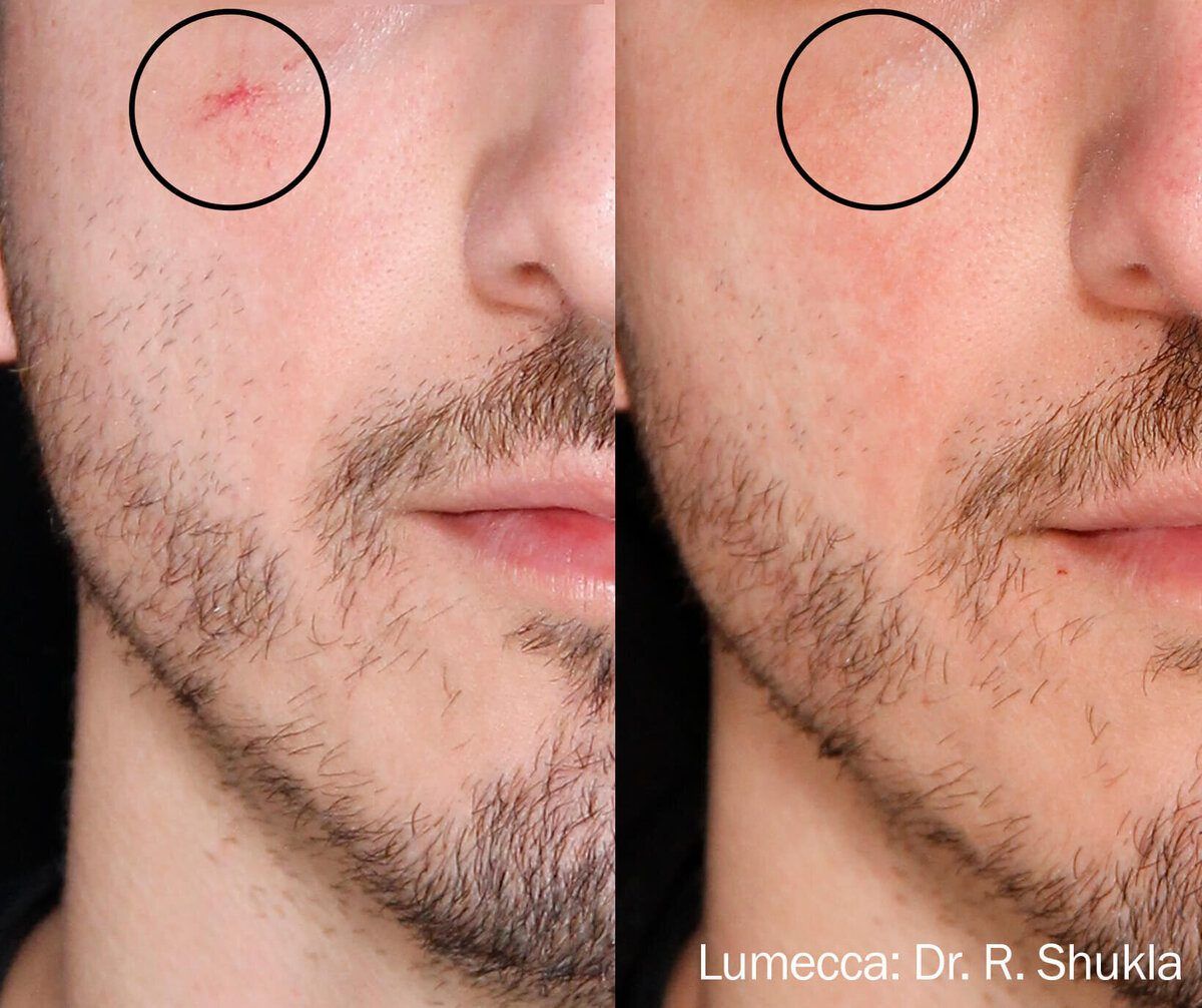 Lumecca IPL Face before and after
