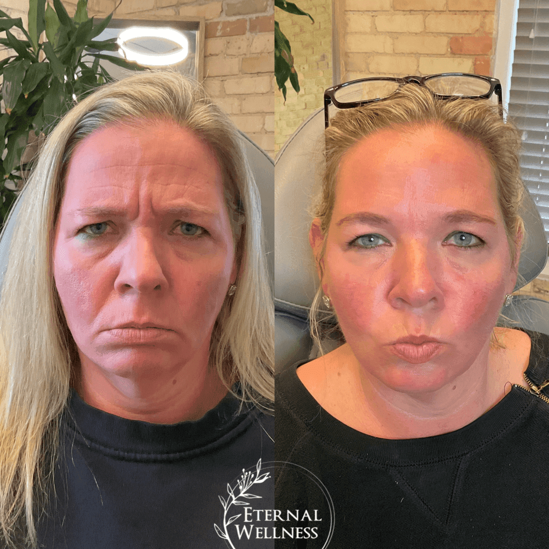 Dysport before and after