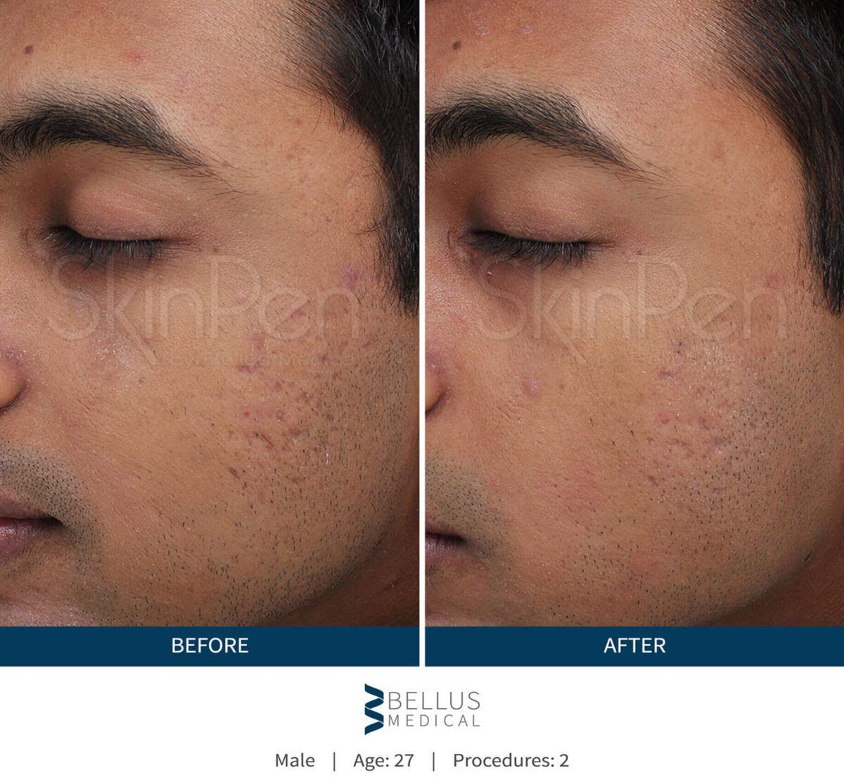 SkinPen before and after