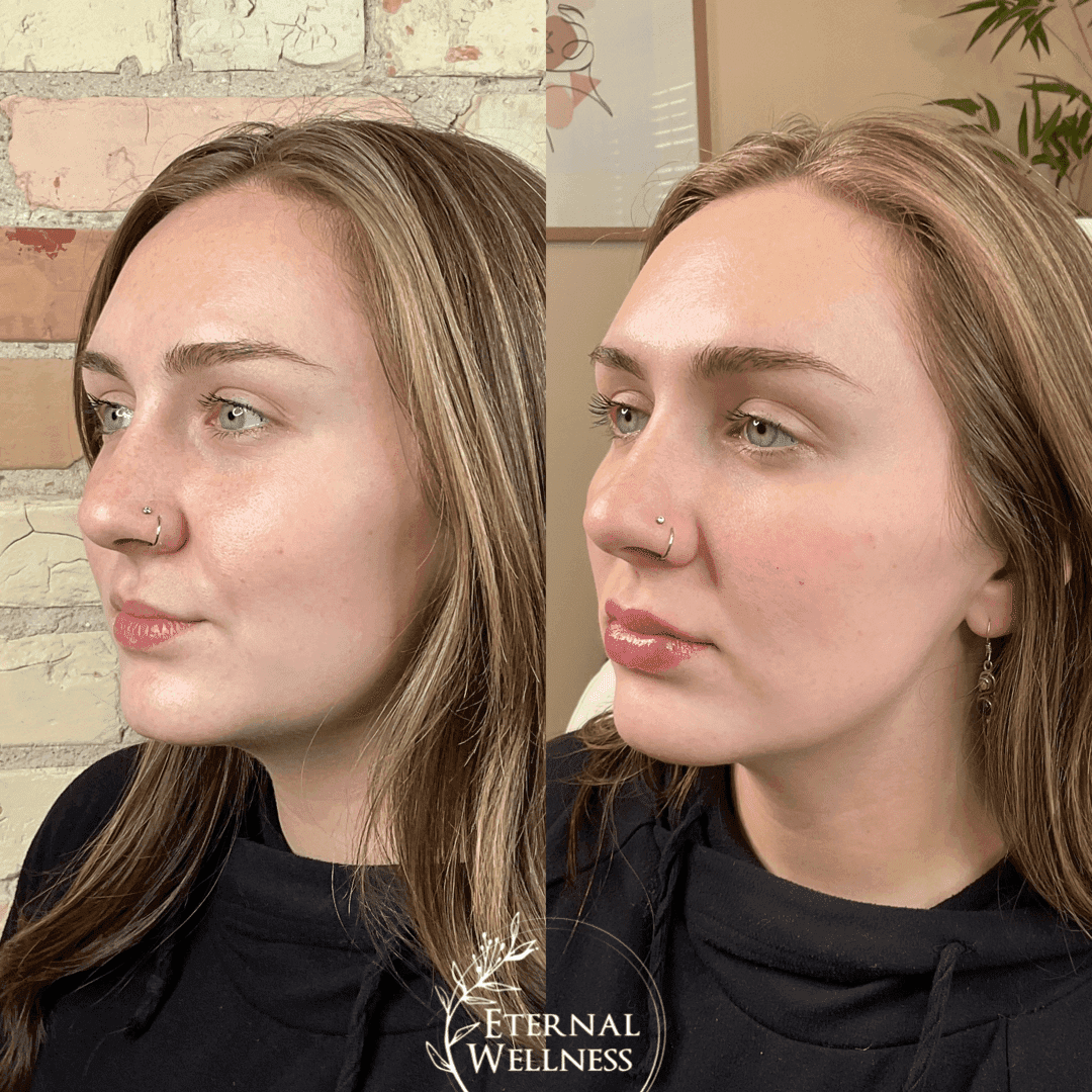 Dermal Fillers before and after