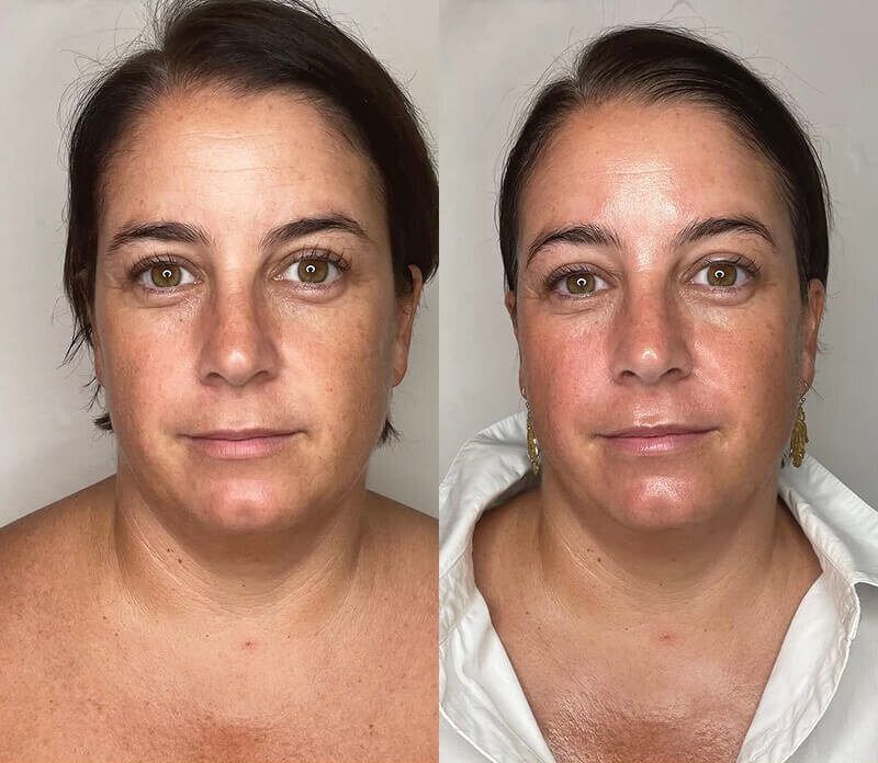 Lymphatic Drainage before and after