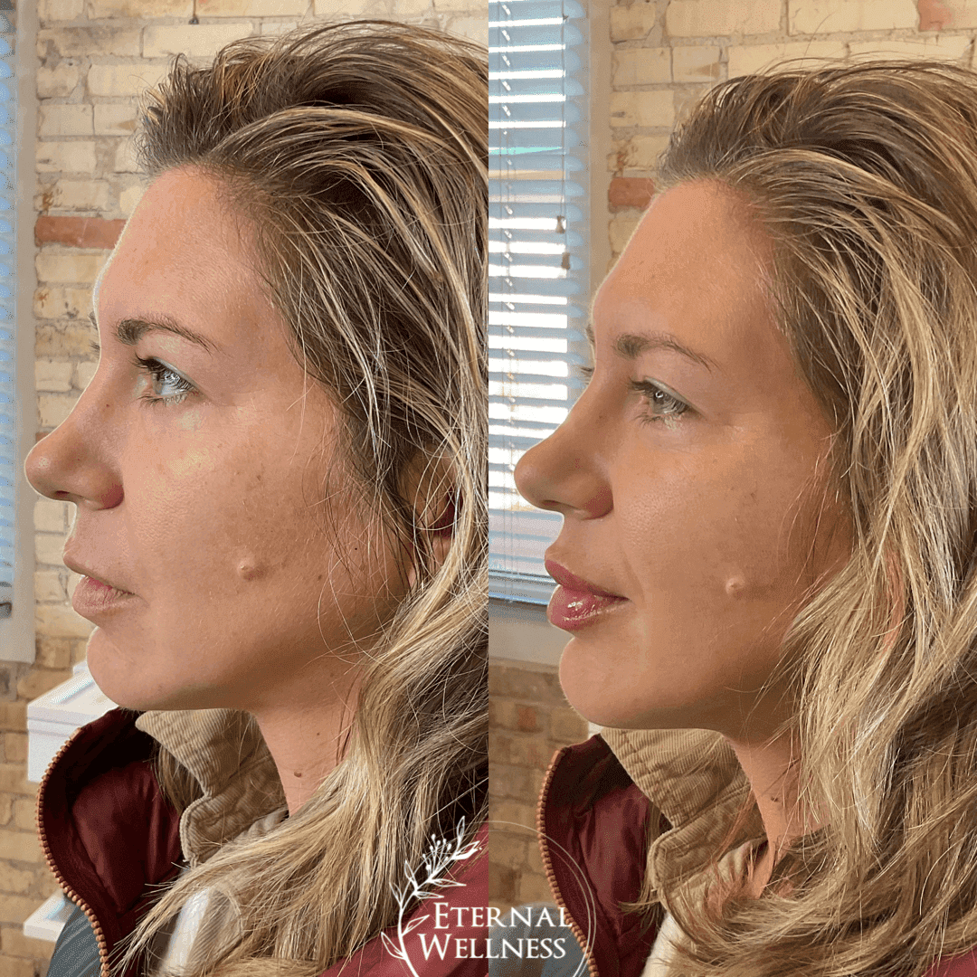 Restylane before and after