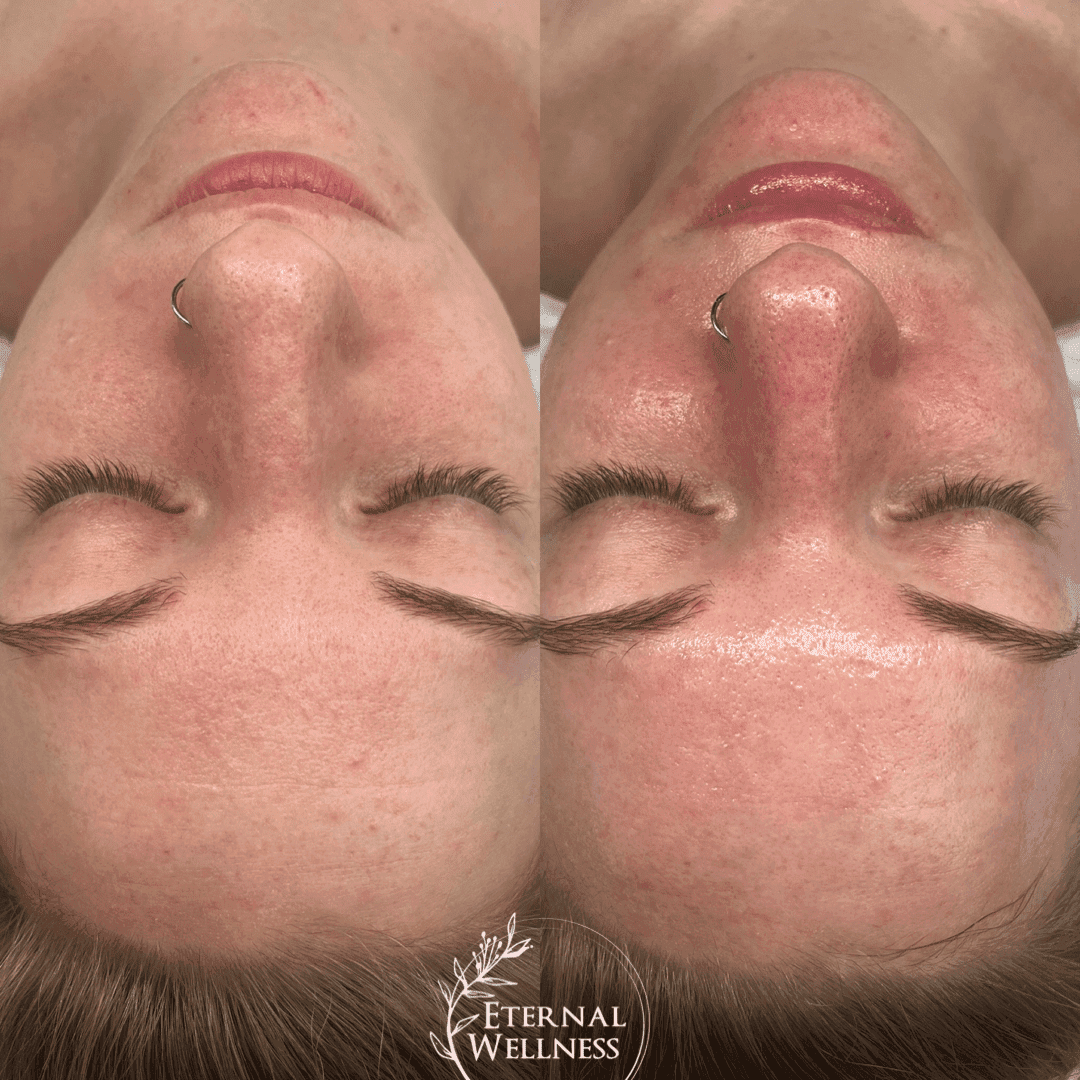 Hydrafacial before and after