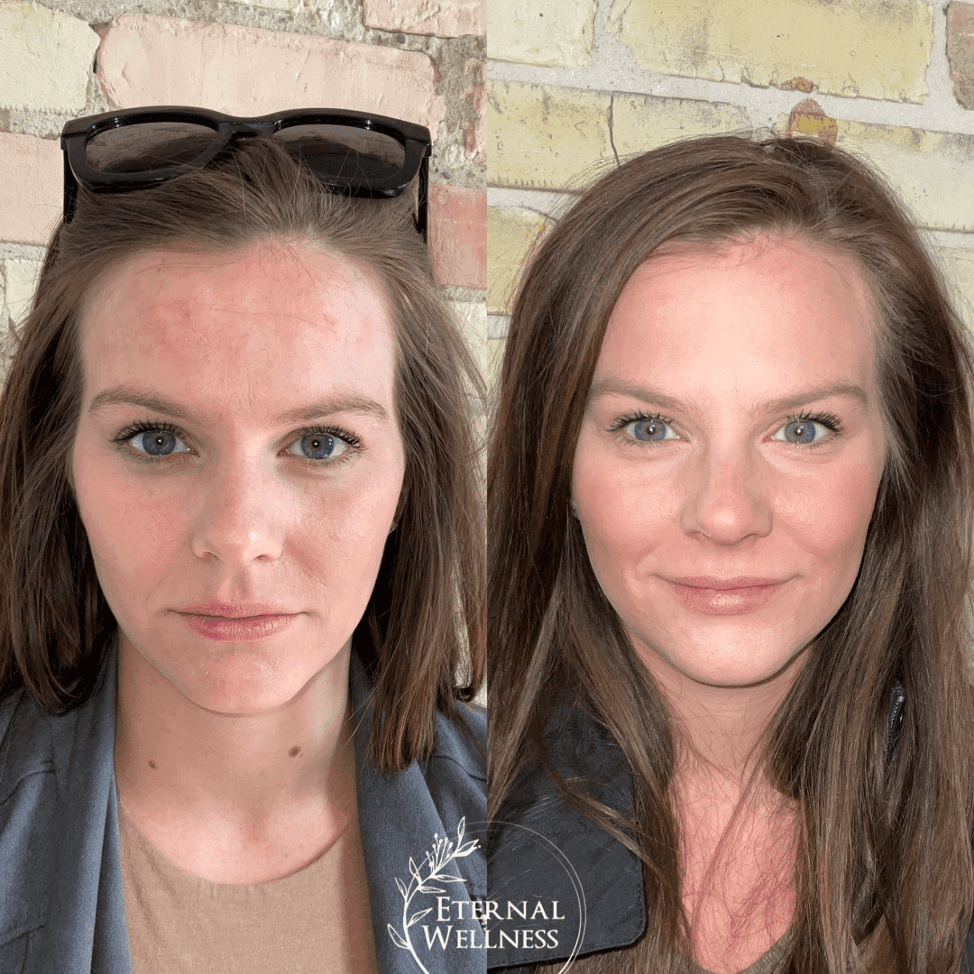 Botox before and after