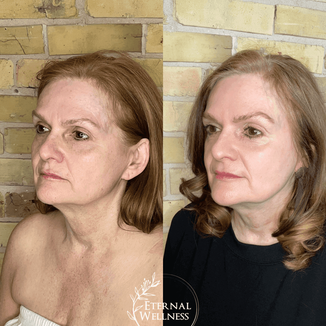 Morpheus8 Face before and after