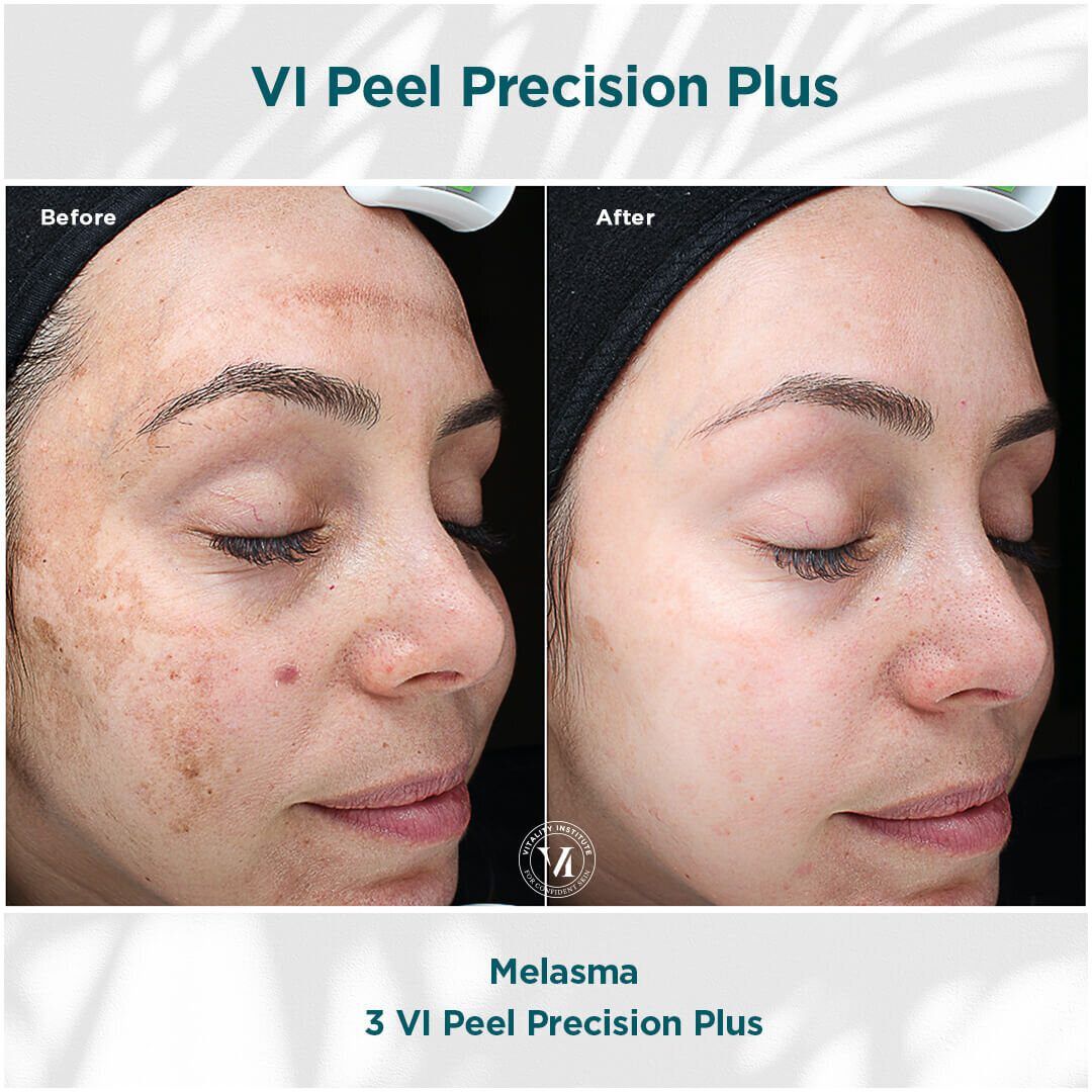 VI Chemical Peel before and after