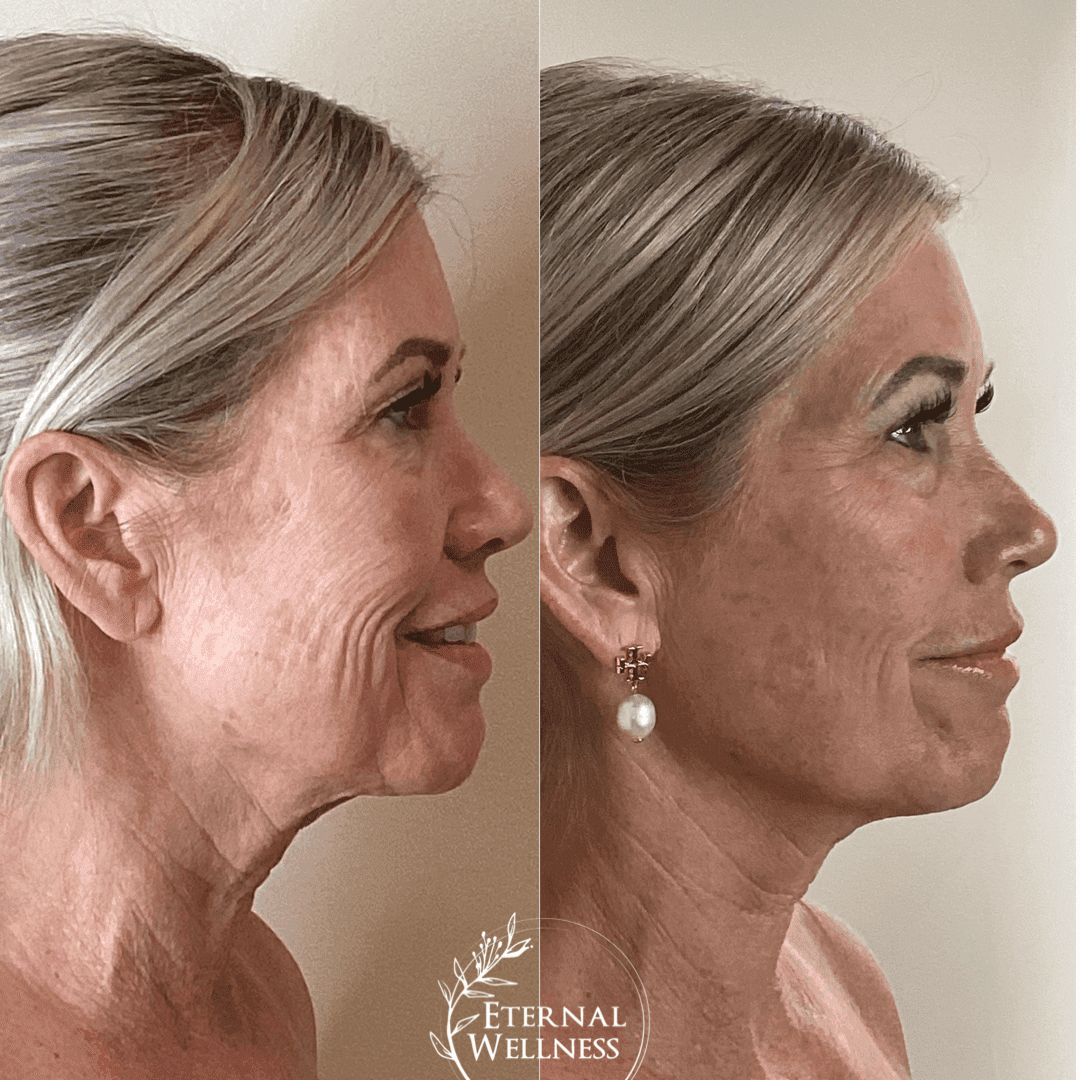 Forma RF before and after