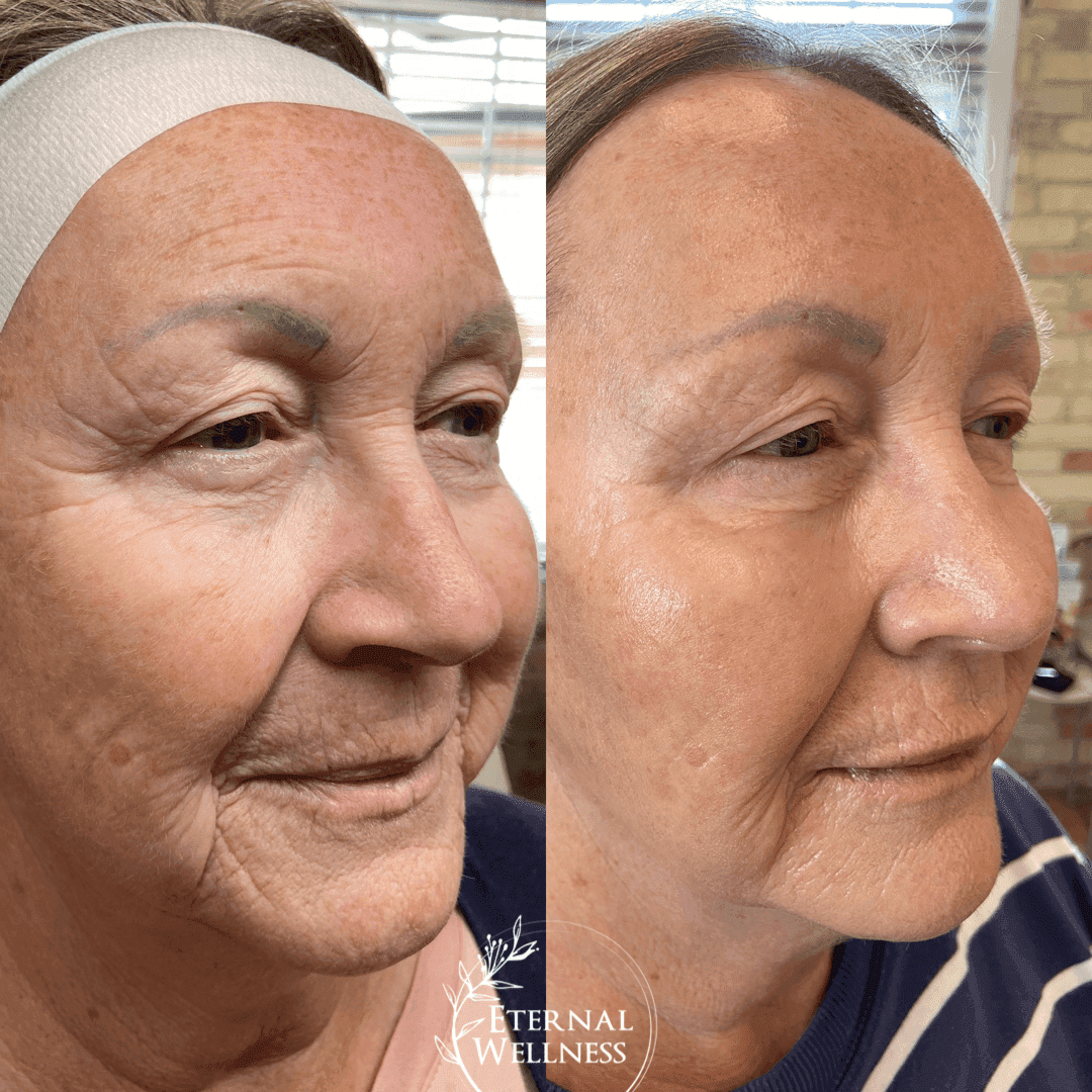 Dermal Fillers before and after