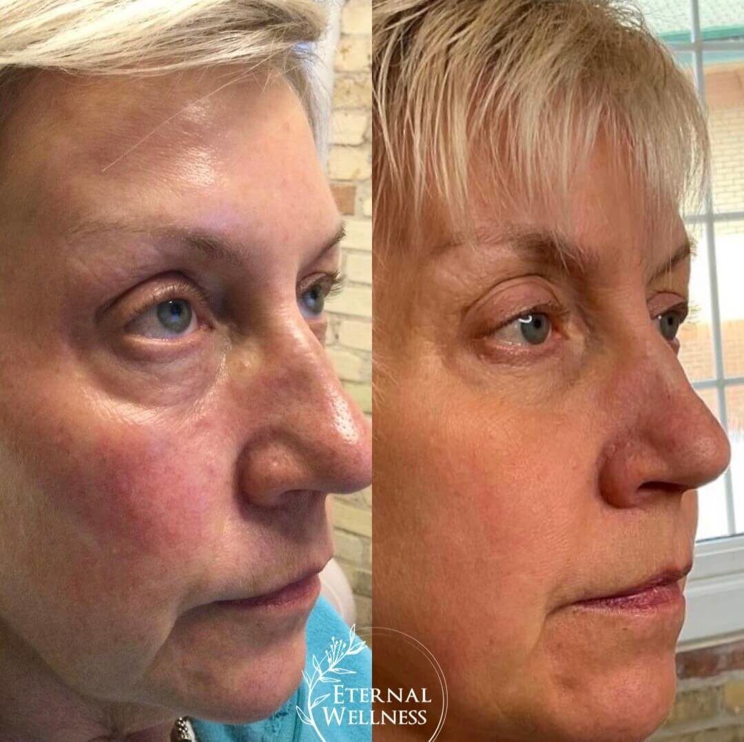 Morpheus8 Face before and after