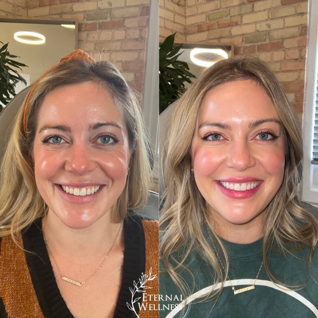 Restylane before and after