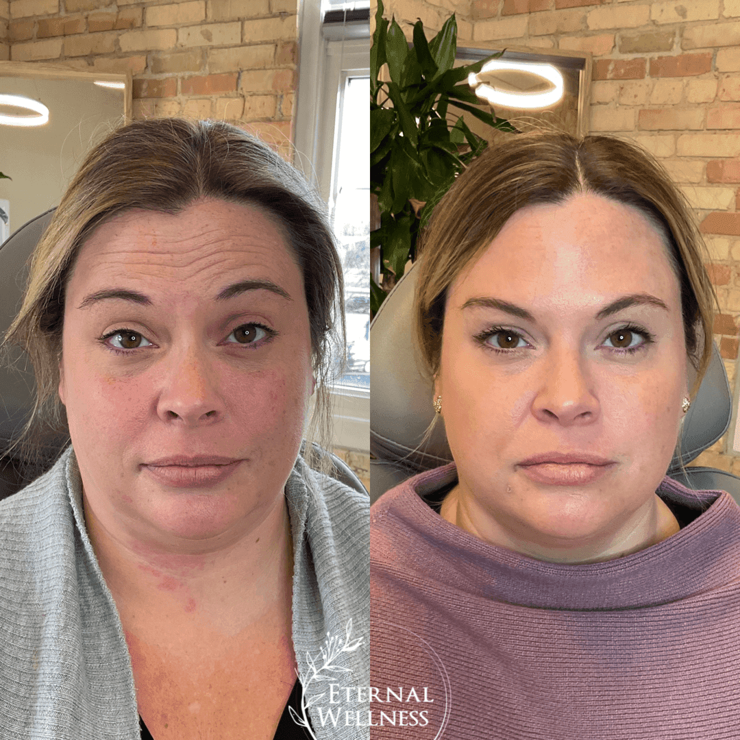 Dysport before and after