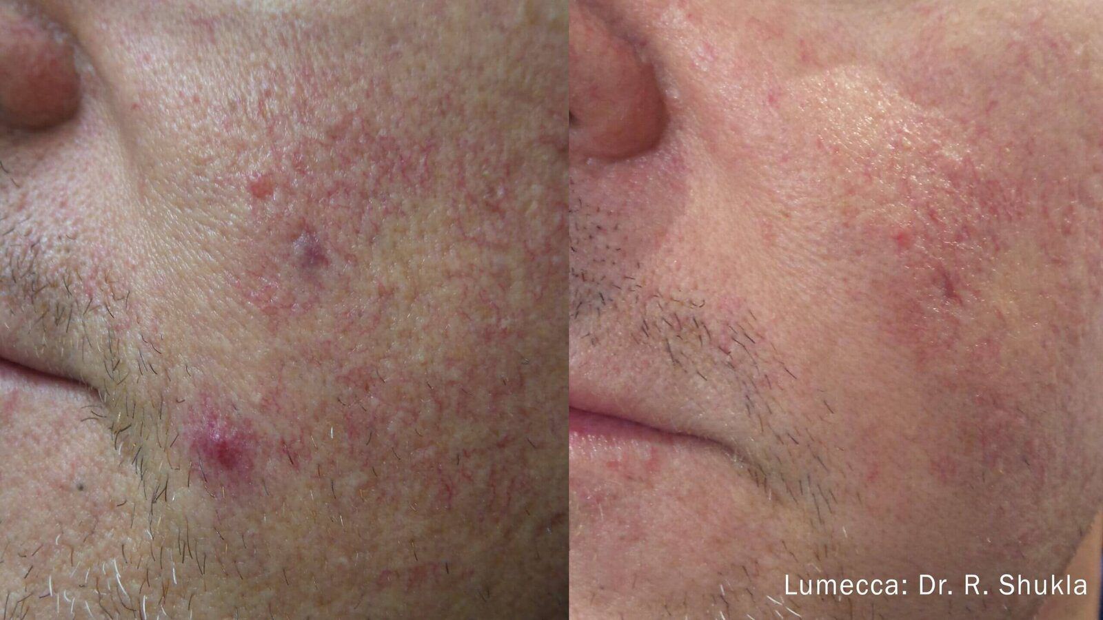 Lumecca IPL Face before and after