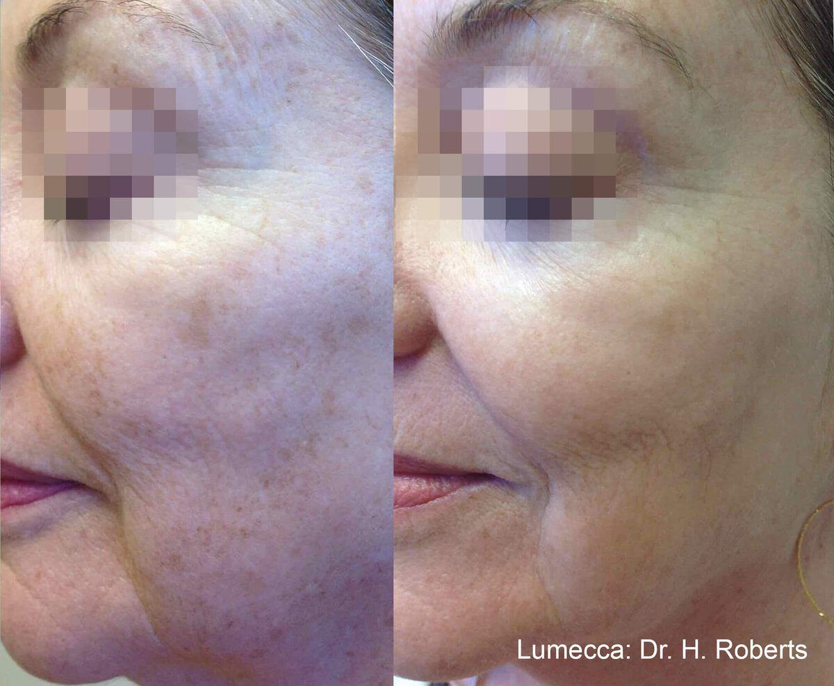 Lumecca IPL Face before and after