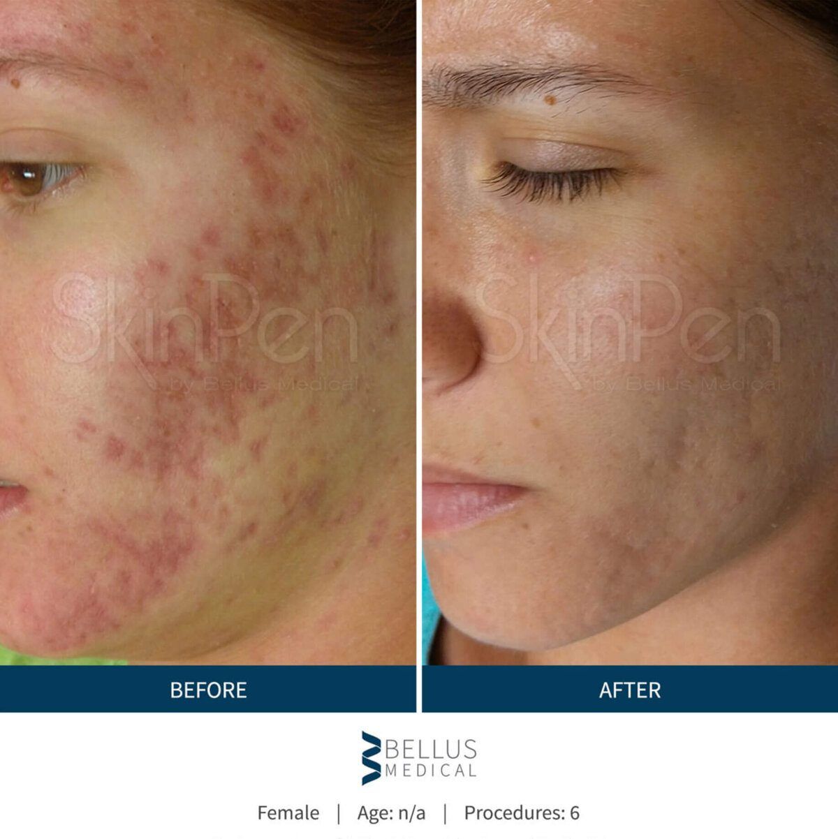 SkinPen before and after