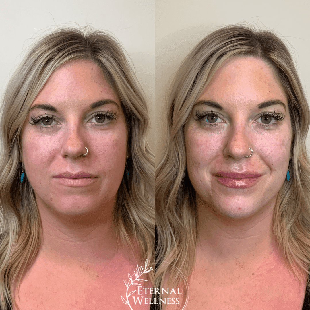 Dermal Fillers before and after