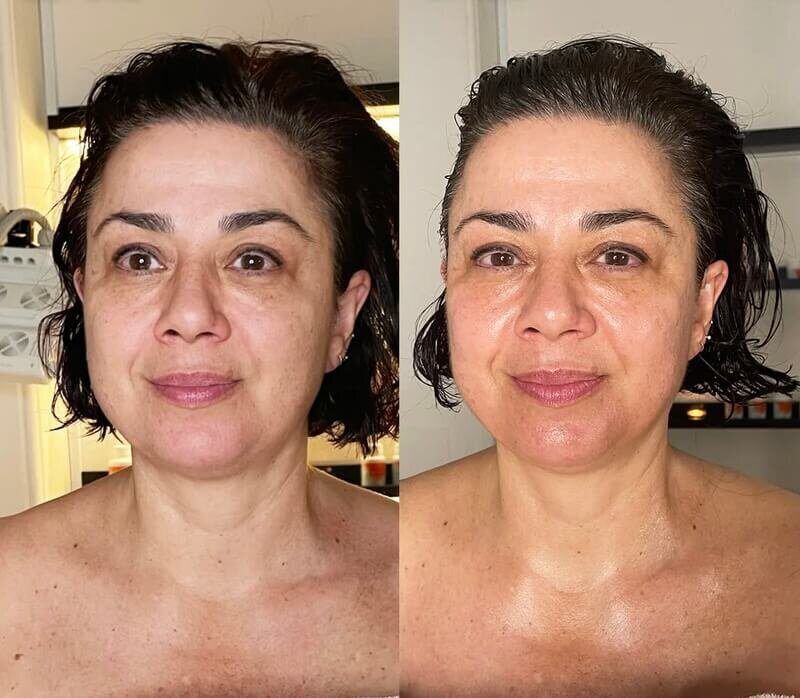Lymphatic Drainage before and after