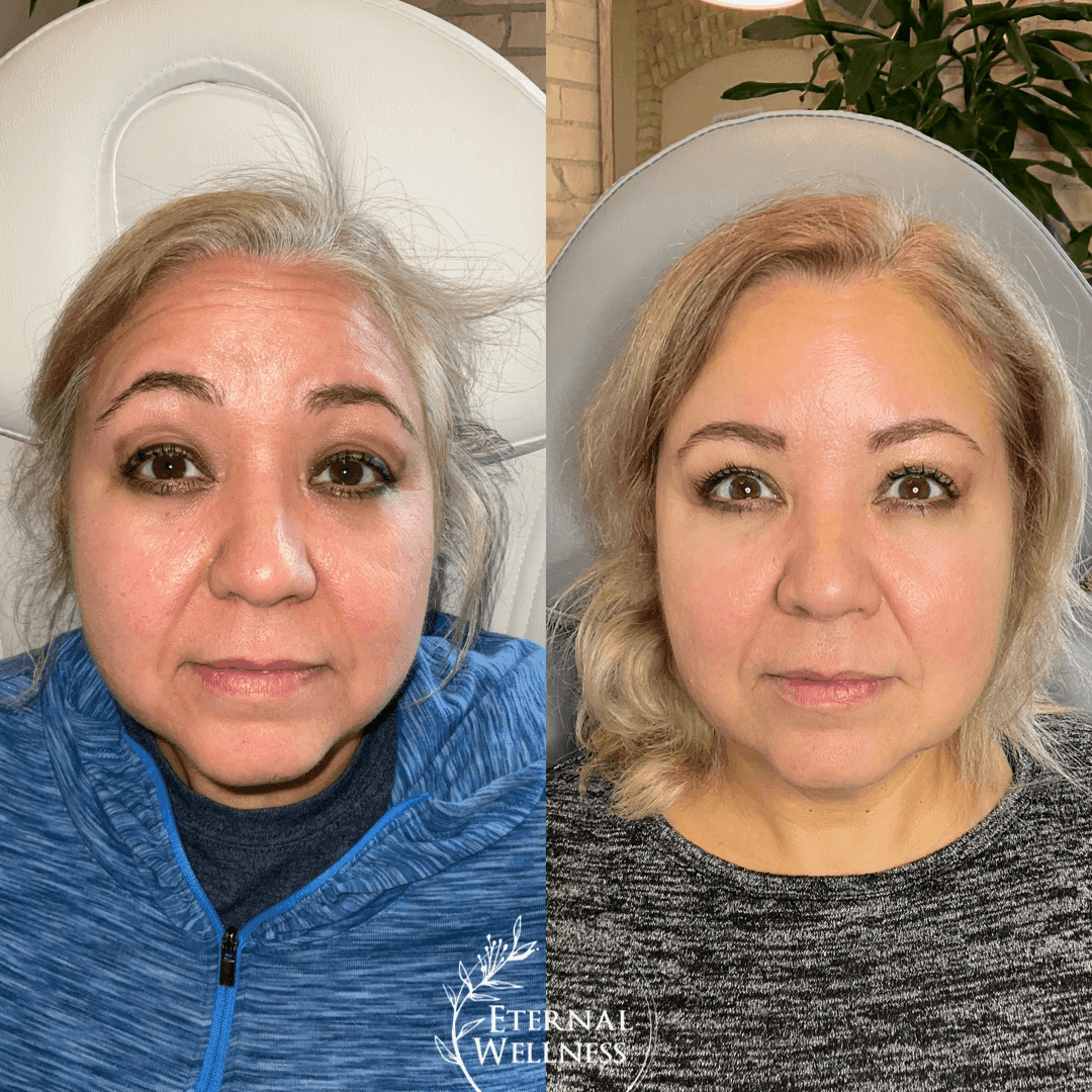 Botox before and after